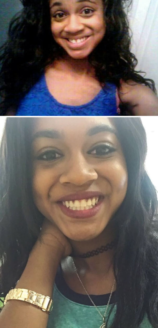 Thank God For Braces