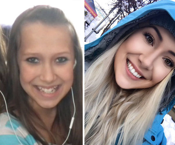 All I Gotta Say Is Thank God For Braces