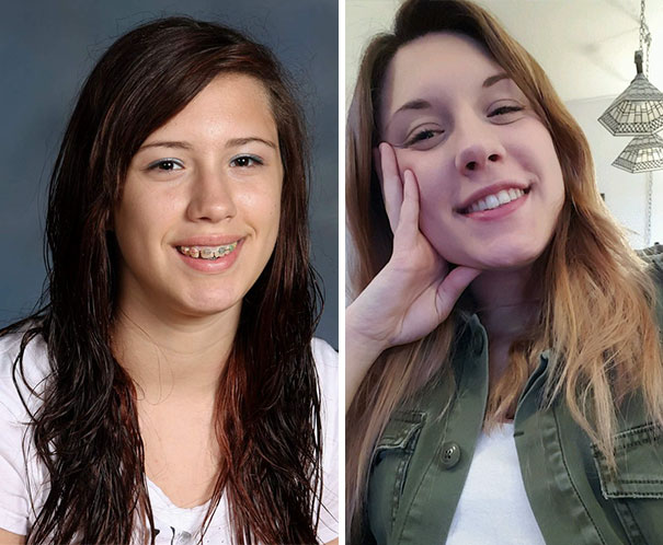 Let Just Take This Second To Thank Braces