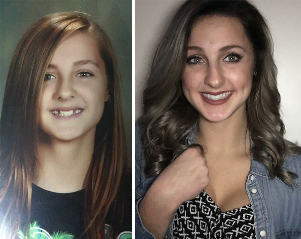 Thank Jesus For Braces