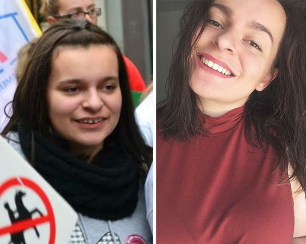 Thank You Braces Never See You Again