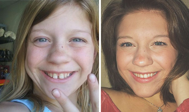 I Thank The Heavenly Father Everyday For Braces Bless Up