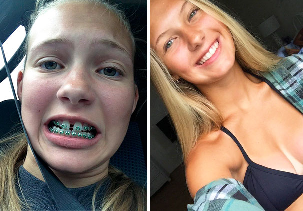Thank God For Braces