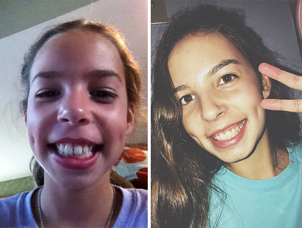 Thank God For Braces
