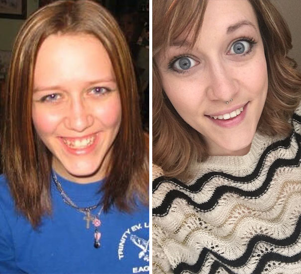 Before And After Braces