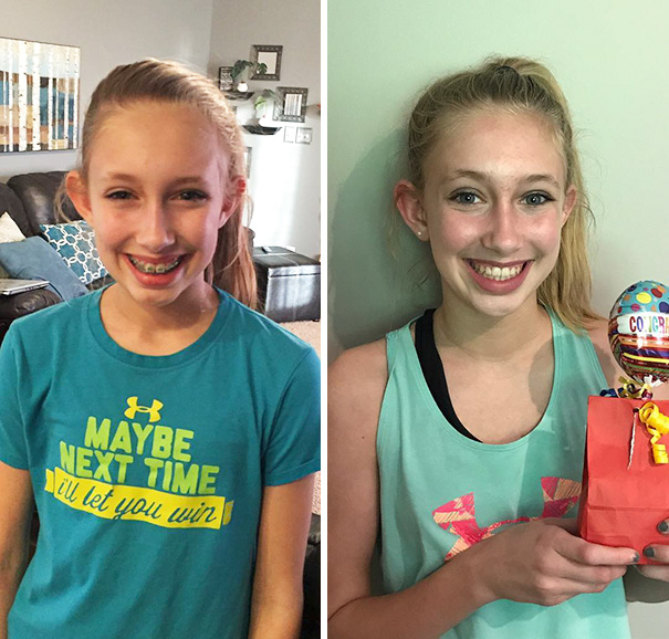 This Was The Rest Of Our Excitement Today, Haley Got Her Braces Off