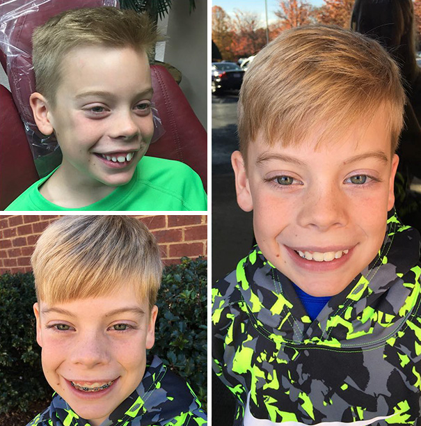 What A Difference A Year Makes. No More Top Braces