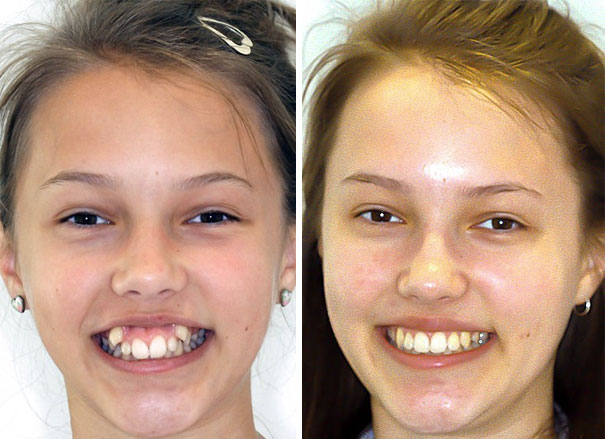 Before And After Braces