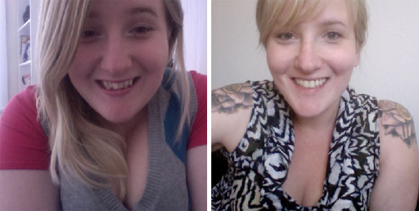 At Age 23 My Braces Are Finally Off And I Couldn't Be Happier