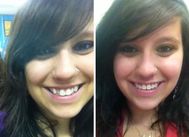 I Got My Braces Off, After A Year And Two Months