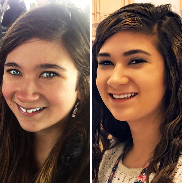 After 3 Years And 7,382 Appointments Braces Are Off