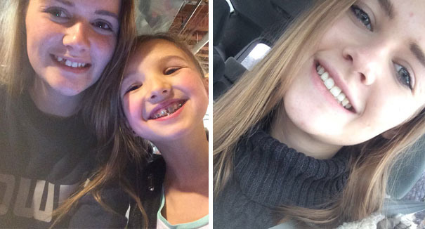 After 4 Years Total Of Braces, Surgeries, And Countless Times Going To The Dentist, I Finally Have A Full Smile