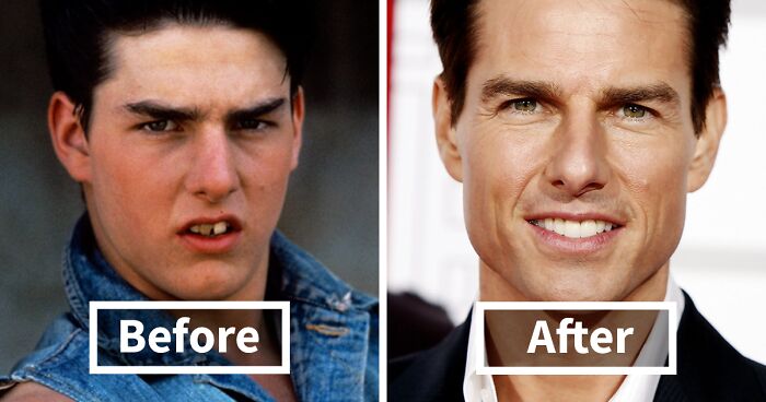 114 Incredible Before & After Transformations Of People Who Wore Braces