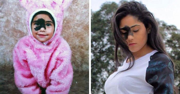 Girl Who Was Told That Her Rare Birthmark Looks Ugly Chose Not To Remove It, And Here’s Why