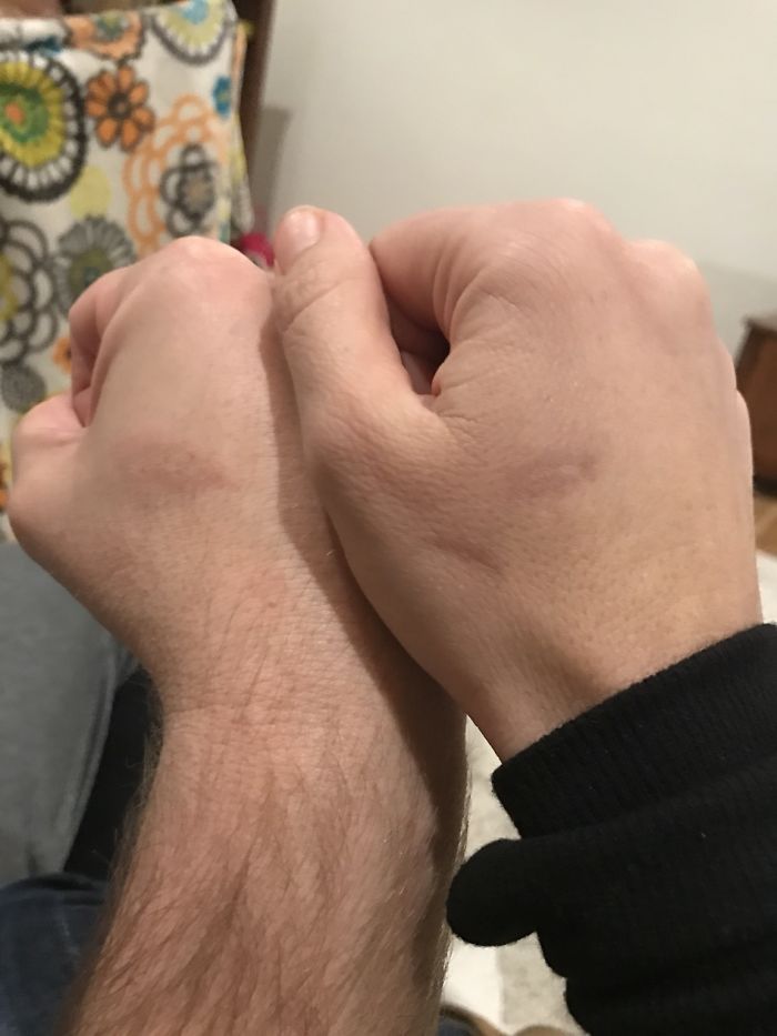 Thanks To Our Toaster Oven We Now Have Matching Husband And Wife Scars For Life