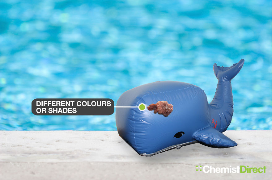 Skin Cancer On Inflatables: 8 Of The Most Common Symptoms Of Skin Cancer