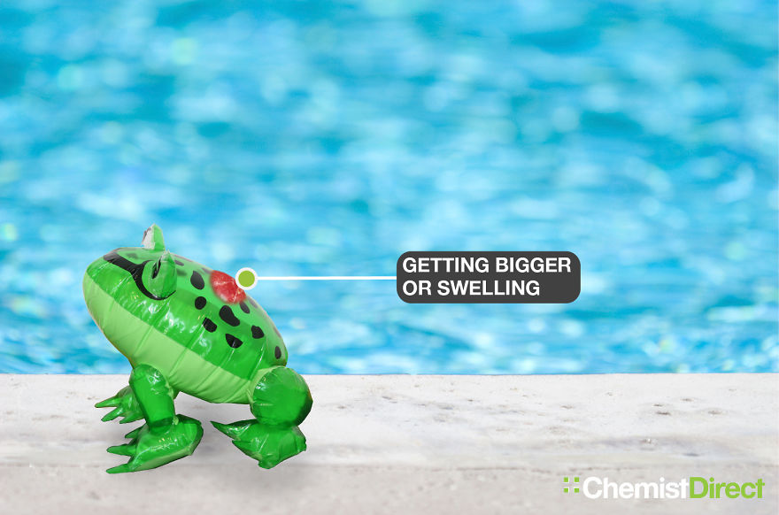 Skin Cancer On Inflatables: 8 Of The Most Common Symptoms Of Skin Cancer