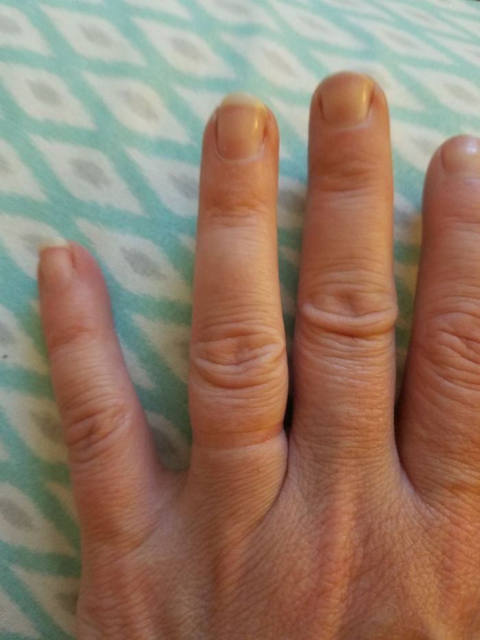 15 Years Wearing My Wedding Band, It Has Been Off For A Week(due To A Rash😉)