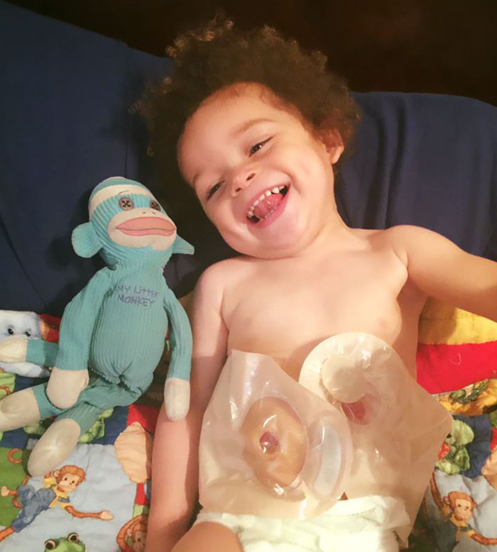 hirschsprungs-disease-jameus-dallas-lynn-13 hirschsprungs-disease-jameus-dallas-lynn-13