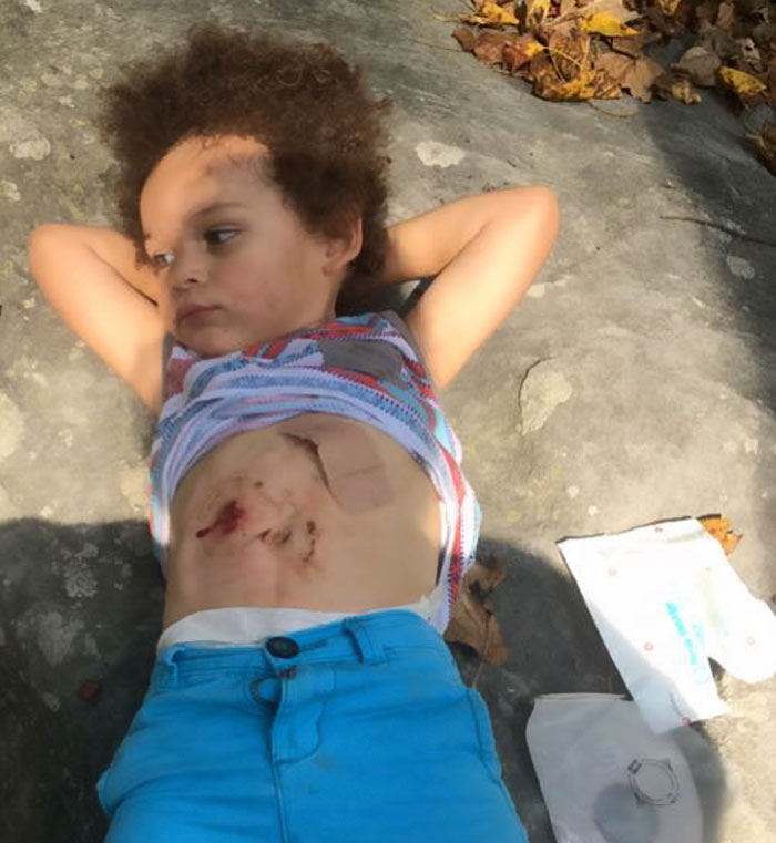 hirschsprungs-disease-jameus-dallas-lynn-14 hirschsprungs-disease-jameus-dallas-lynn-14