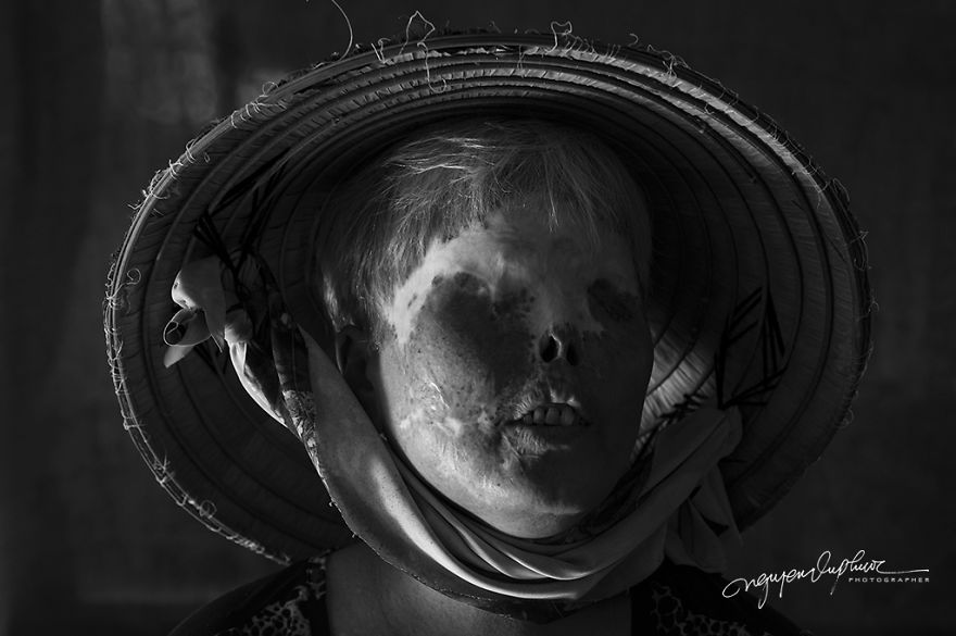 More Brutal Than Death Reality Of Acid Burn Victims Of Vietnam