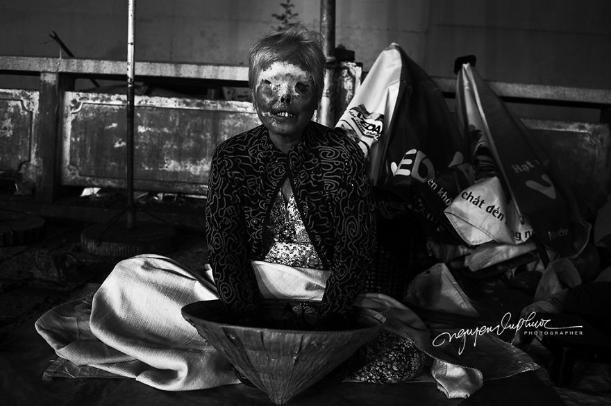 More Brutal Than Death Reality Of Acid Burn Victims Of Vietnam