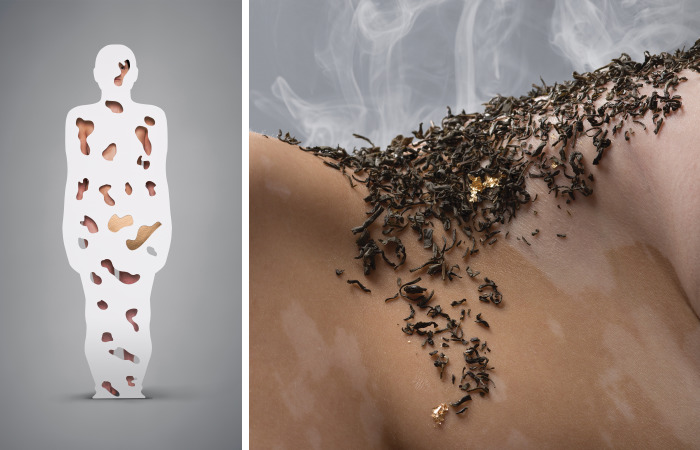 The Vitiligo Project