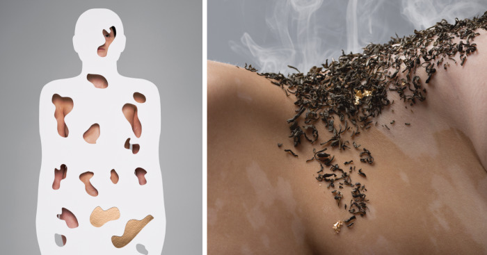 The Vitiligo Project