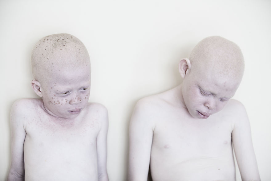 Stunning Photos Show The Beauty Of Albino Children To Raise Awareness Of Their Heartbreaking Situation In Tanzania Stunning Photos Show The Beauty Of Albino Children To Raise Awareness Of Their Heartbreaking Situation In Tanzania