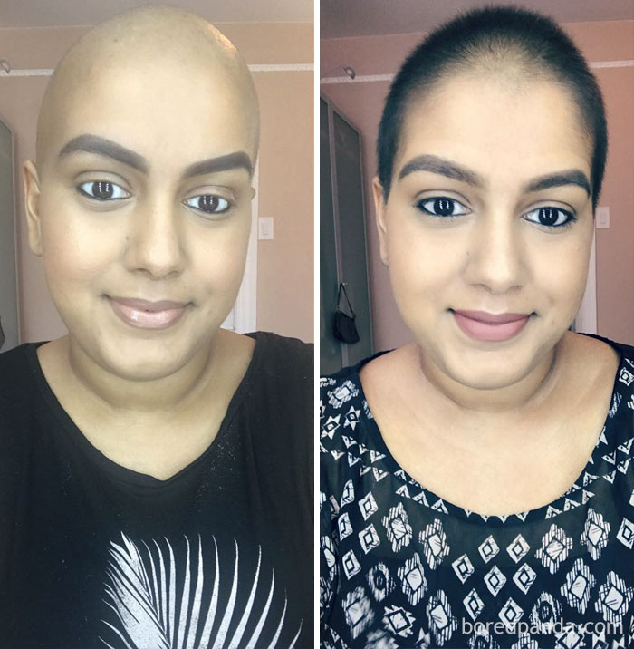 1 Month Of Hair Growth. Still Not Feeling 100% But Getting Better