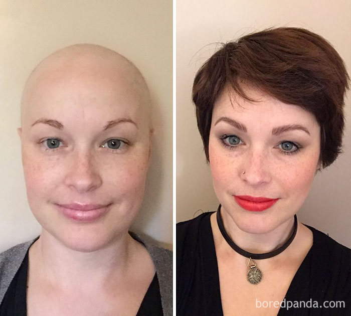 1 Year Post Chemo. This Time Last Year I Had Completed My 6th & Final Cycle Of Chemo