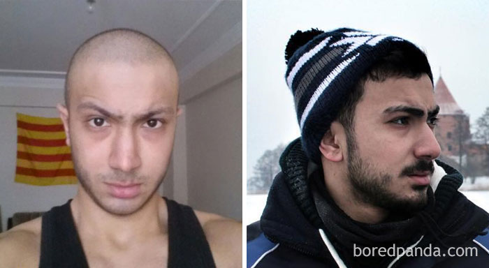 I Was Diagnosed With Primary Mediestinal Large B Cell Lymphoma. I Was Told That If I Don't Take Chemotheraphy I Will Be Dead In Two Weeks. Now I Am Cancer Free For 2.5 Years!