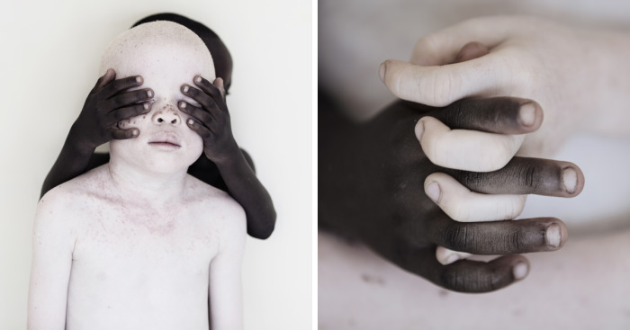 Stunning Photos Show The Beauty Of Albino Children To Raise Awareness Of Their Heartbreaking Situation In Tanzania