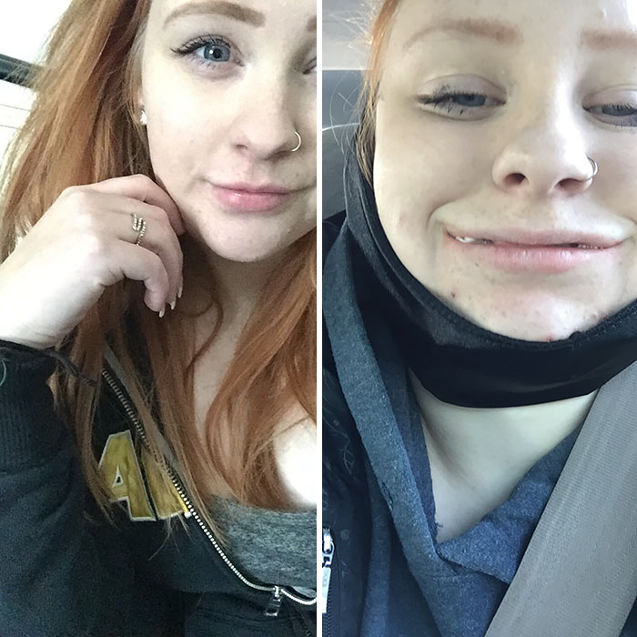 Got My Wisdom Teeth Out Today