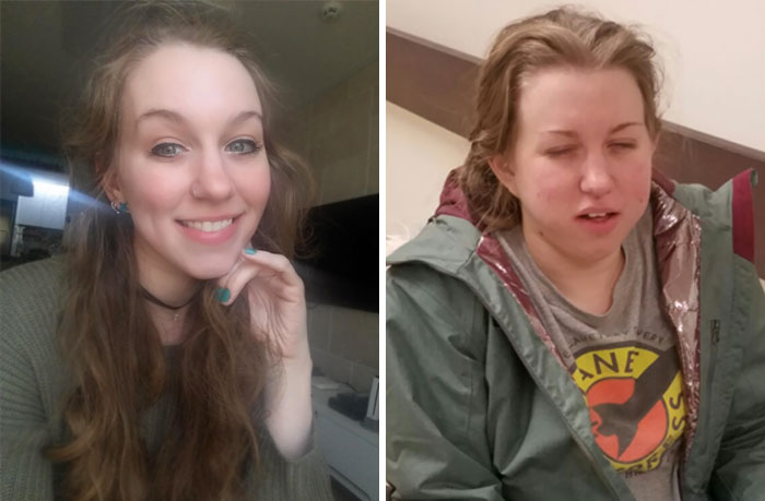 Got My Wisdom Teeth Removed