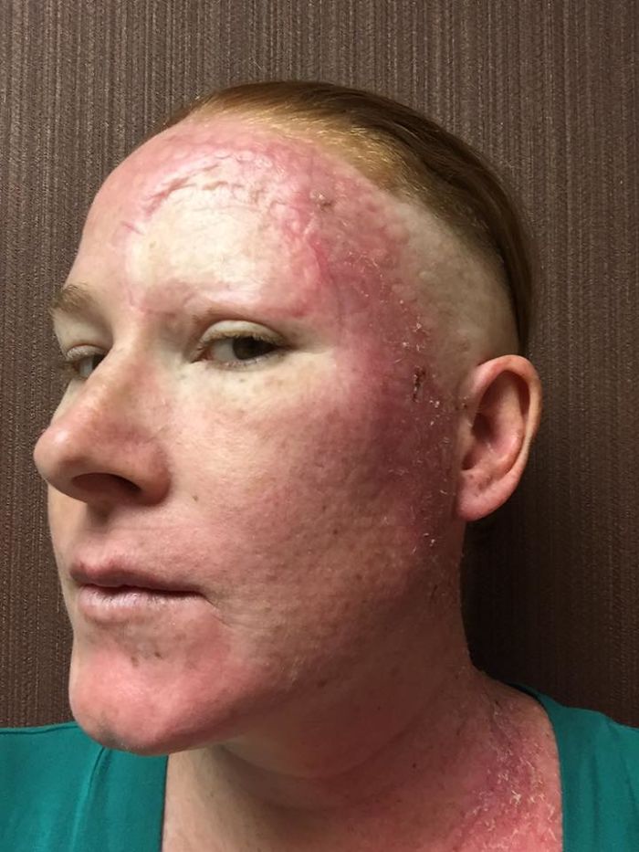 If This Mom's Before & After Photos Don't Scare You About Skin Cancer, Nothing Will If This Mom's Before & After Photos Don't Scare You About Skin Cancer, Nothing Will