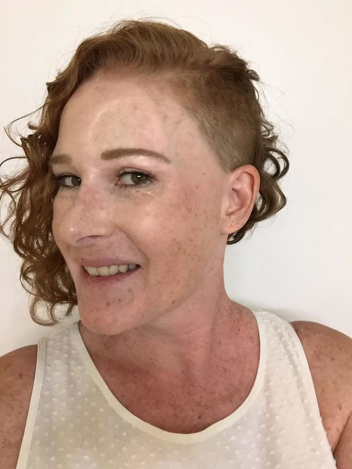 If This Mom's Before & After Photos Don't Scare You About Skin Cancer, Nothing Will If This Mom's Before & After Photos Don't Scare You About Skin Cancer, Nothing Will