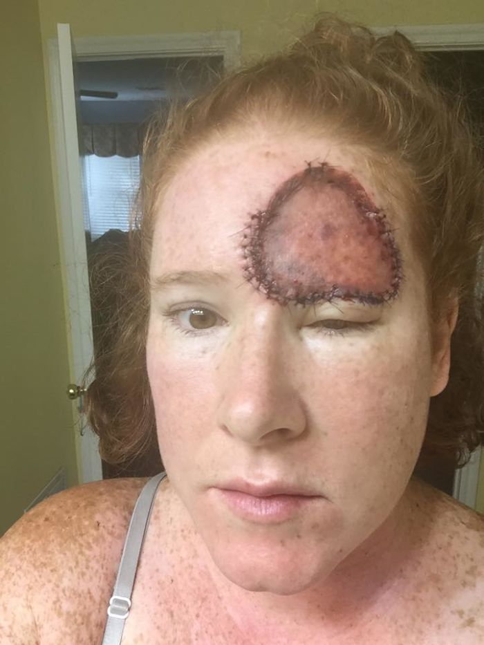 If This Mom's Before & After Photos Don't Scare You About Skin Cancer, Nothing Will If This Mom's Before & After Photos Don't Scare You About Skin Cancer, Nothing Will