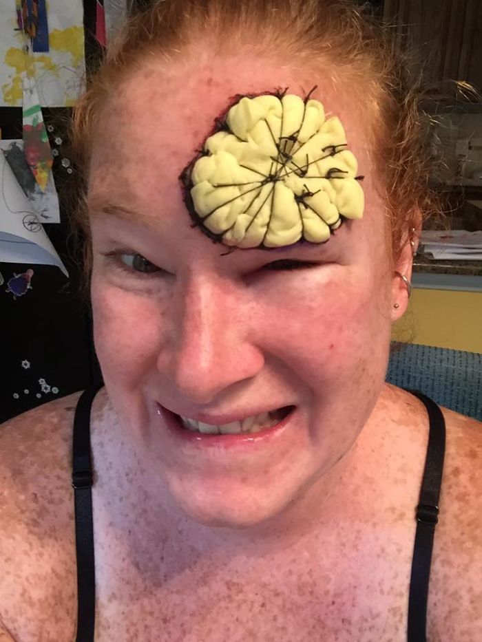 If This Mom's Before & After Photos Don't Scare You About Skin Cancer, Nothing Will If This Mom's Before & After Photos Don't Scare You About Skin Cancer, Nothing Will