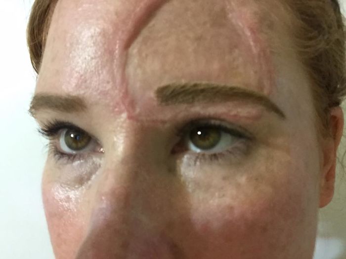 If This Mom's Before & After Photos Don't Scare You About Skin Cancer, Nothing Will If This Mom's Before & After Photos Don't Scare You About Skin Cancer, Nothing Will