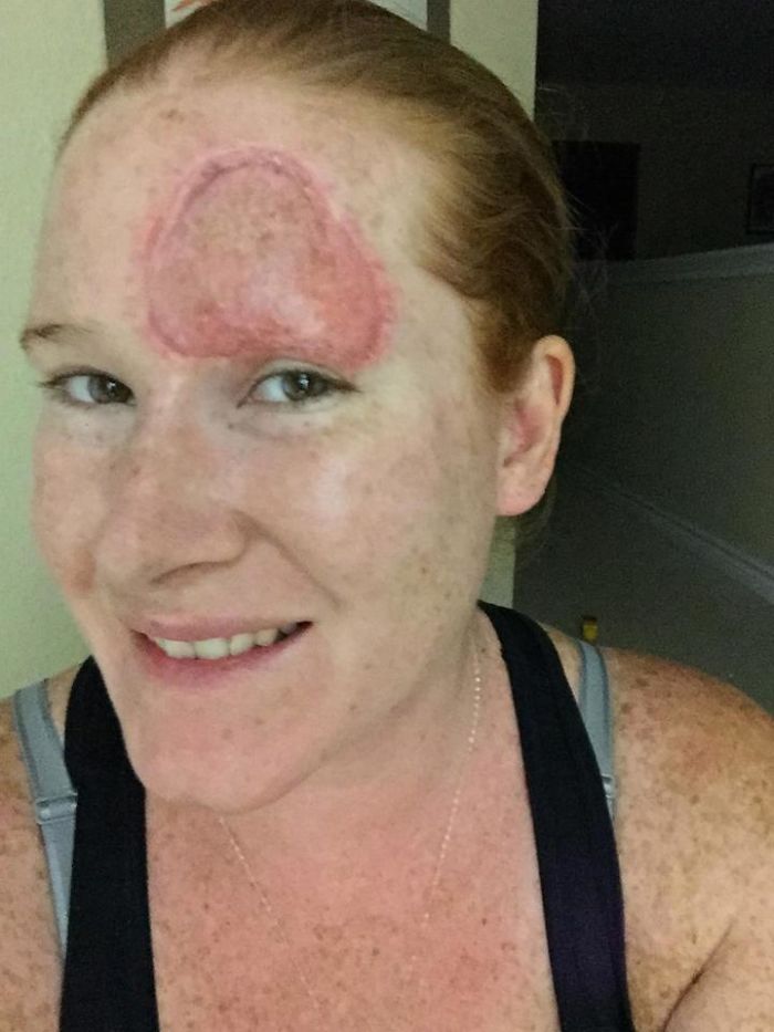 If This Mom's Before & After Photos Don't Scare You About Skin Cancer, Nothing Will If This Mom's Before & After Photos Don't Scare You About Skin Cancer, Nothing Will