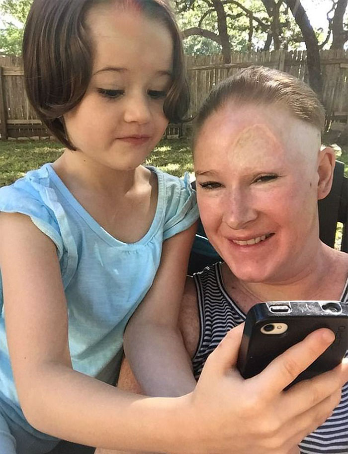 If This Mom's Before & After Photos Don't Scare You About Skin Cancer, Nothing Will If This Mom's Before & After Photos Don't Scare You About Skin Cancer, Nothing Will
