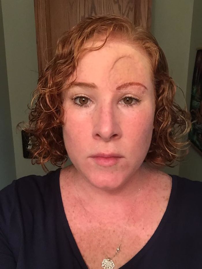 If This Mom's Before & After Photos Don't Scare You About Skin Cancer, Nothing Will If This Mom's Before & After Photos Don't Scare You About Skin Cancer, Nothing Will