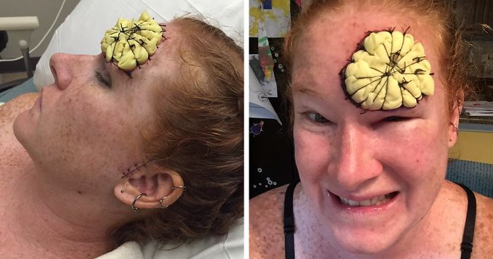 If This Mom’s Before & After Photos Don’t Scare You About Skin Cancer, Nothing Will