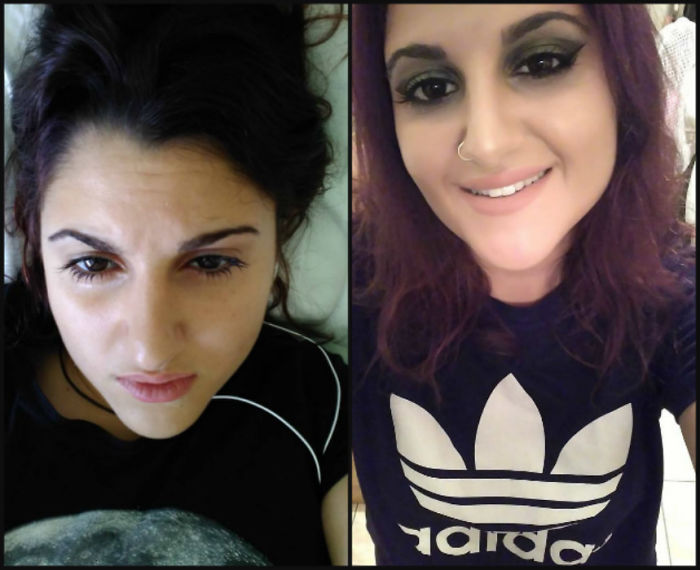 I've Been Suffering From Depression Since I Was 14 Years Old. I Was Not Treated Nor Diagnosed Because My Parents And Everyone Around Me Thought I Was Ok Although I Was Clearly Not. I Attempted To Take My Life Many Times. Fast Forward To The Present Day, I Am Diagnosed With A Type Of Bipolar Disorder And Mild Ocd And Suffer From Severe Anxiety And Panic Attacks. I Was On Medication For One Year (Depakine Chrono,zoloft,xanax) And They Helped Me. During Summer I Had A Major Manic Episode Which Led Me To An Urgent Hospitalization In A Mental Clinic. The First Picture Is Taken After I Was Given Many Sedatives And Had A Depressive Episode. Here I'm Lying Crying On My Bed In The Clinic. The Second Picture Was Taken A Month After I Was Out And I Was Ready To Drink My Problems And Pain Away. What Hurts Me Is That Even When I Was Lying There, Totally Succumbed To My Illness, My Mother, Nobody Thought My Pain Was Real. "It's All In Your Head, Stop Taking Pills And Get Out Of Here". Mental Disorders Are Real. Stop The Victim Blaming And Imposing Your Personal Views, Demanding Us To Be Happy.suicide Is Too Real. Listen To Those Who Suffer, Don't Make Them "Prove Their Pain" So You Can Believe Them And Do Not Belittle Their Pain Or Dismiss It Entirely. Depression Is Both Those Faces. For Those Who Suffer, Please Get Your Treatment/therapy Or Call A Suicide Prevention Line. We Need You Around. I Know You Hurt But There Are Still Happy Moments For You To Live, I Promise!