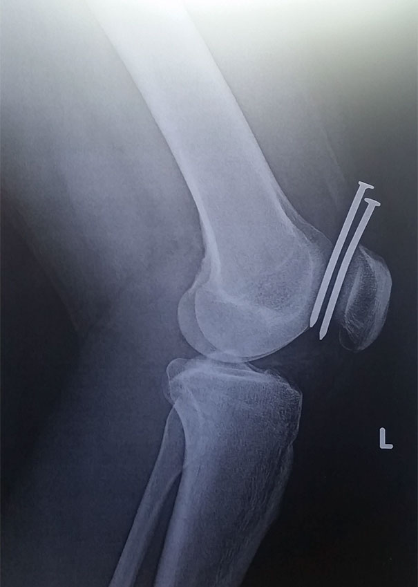 This Guy Had Two Nails From A Nail Gun Hit His Leg, And They Both Missed His Femur And His Kneecap