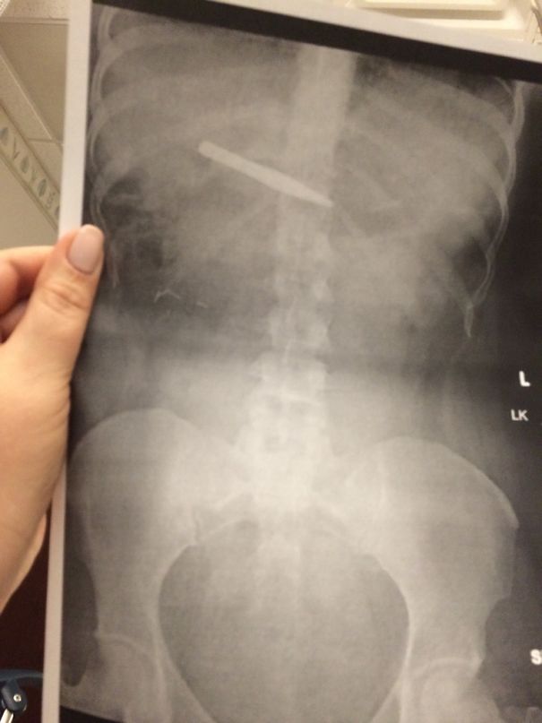 I Swallowed A Tweezers. My Boyfriend Came To The Hospital To Meet Me Before Surgery And I Said 'Did You Say You Were Here For The Girl That Swallowed The Tweezers?' He Said 'Of Course! When Am I Ever Going To Be Able To Use That Line Again?!