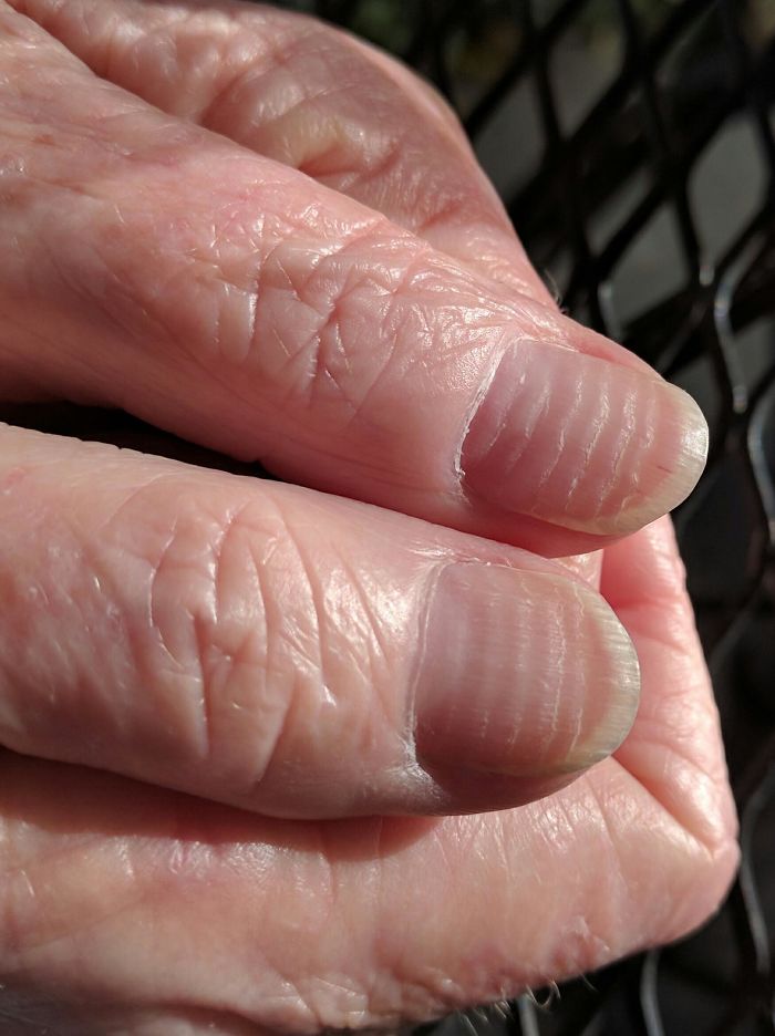 After Six Rounds Of Chemotherapy, My Mother-In-Law's Nails Look Like Tree Rings