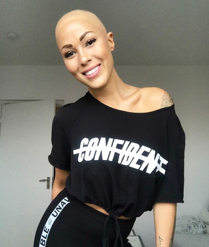 Woman Reveals Her 'Big Secret' She Was Hiding Under The Wig For Years, And Becomes A Model