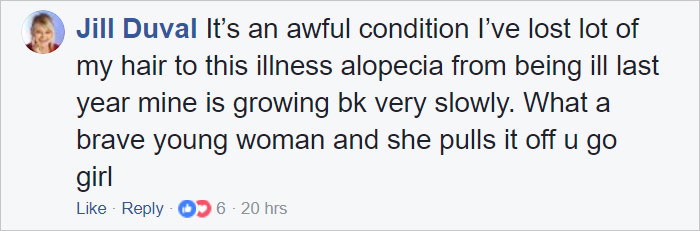 Woman Reveals Her 'Big Secret' She Was Hiding Under The Wig For Years, And Becomes A Model